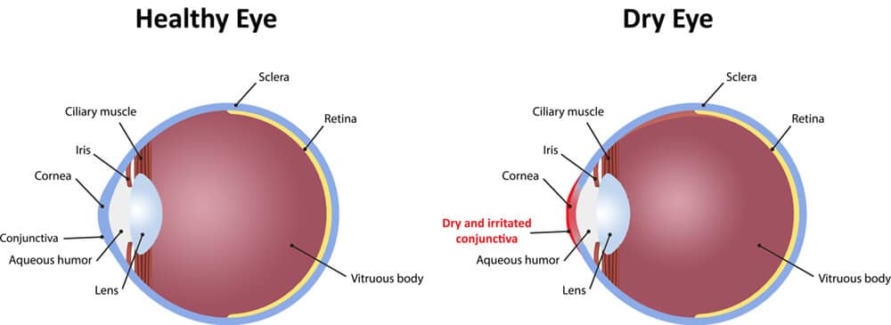 Dry Eye Disease Treatment Clarity Eye Center Dry Eye Disease Treatment Clarity Eye Center